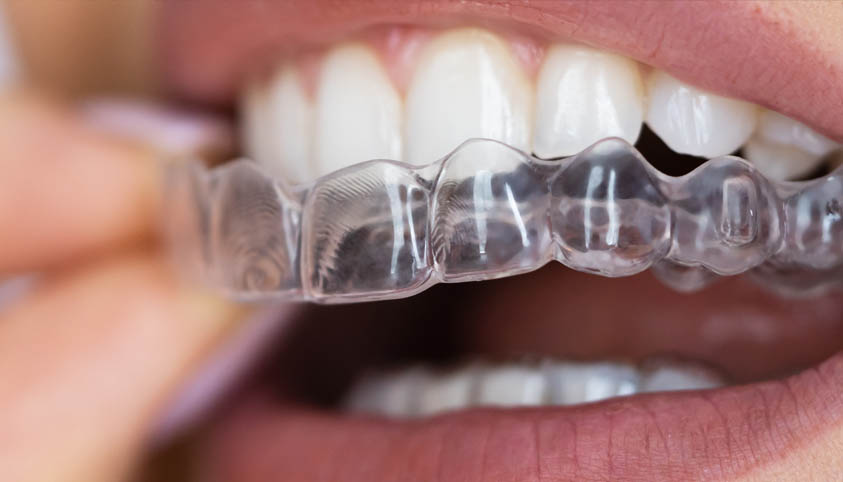 Clear Aligners