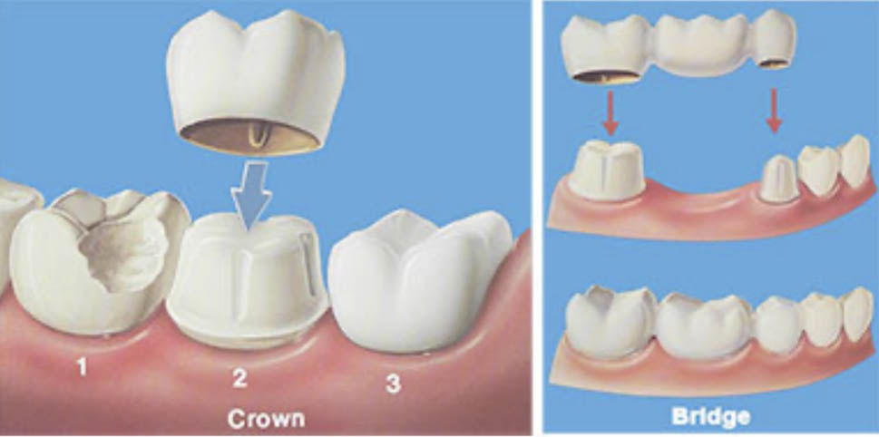 Crowns & Bridges