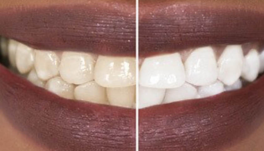  Teeth Whitening